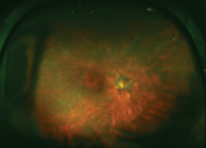 Meeting the challenge of noninfectious uveitis