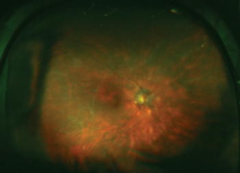 Meeting the challenge of noninfectious uveitis