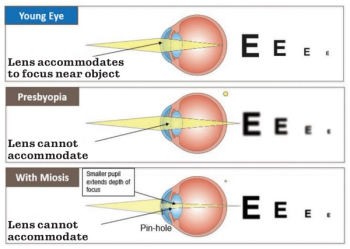 Demographics of presbyopic patients show high demand for solutions beyond eyeglasses.