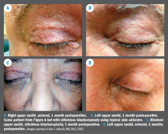 blepharoplasty sutures