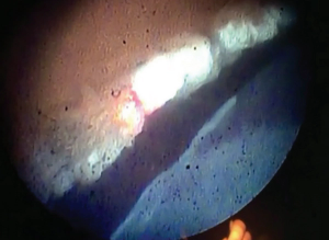 Advantages of incorporating ECP into the surgeon’s armamentarium