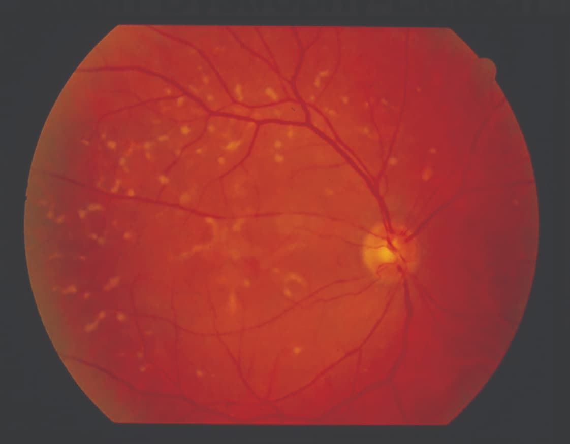 Figure 3: A color fundus photo of a patient with pattern dystrophy. Note the irregularly shaped drusen-like deposits.