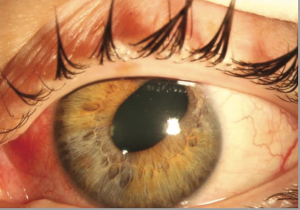 Anterior segment ischemia following three-muscle strabismus surgery