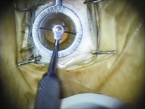 Tips for toric IOL marking