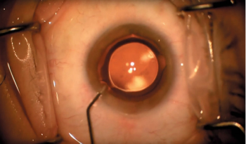 IOP adjustments with tonometry