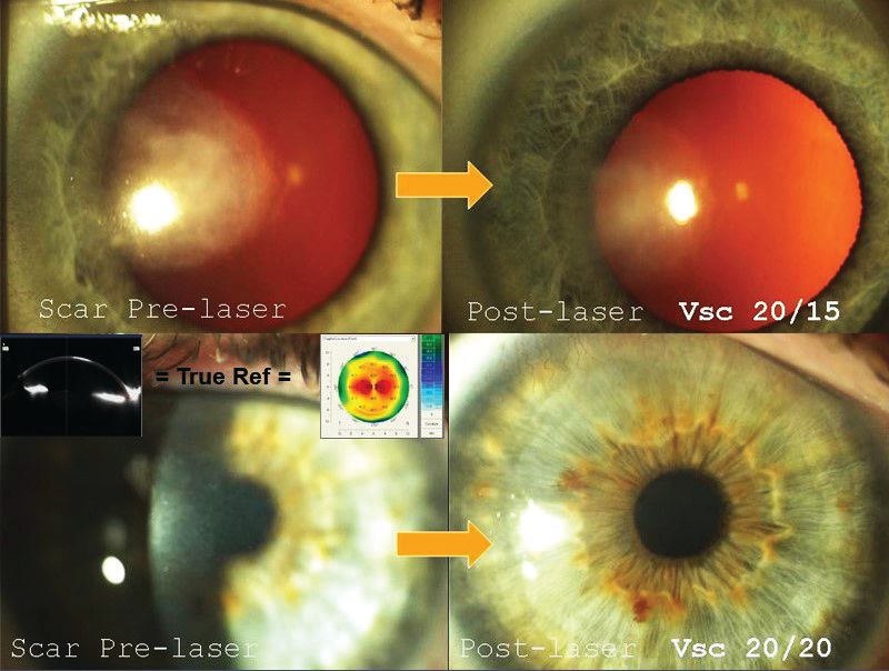 The top left image shows radial keratotomy scars. Images at lower left and right show corneeall scars. (Images courtesy of Arun Gulani, MD, MS) The top left image shows radial keratotomy scars. Images at lower left and right show corneeall scars. (Images courtesy of Arun Gulani, MD, MS)