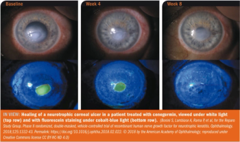 neurotrophic corneal ulcer