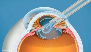 Bausch + Lomb announce publication, positive topline results of enVista Envy trial data