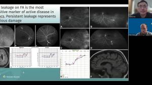 NeuroOp Guru: Susac syndrome and fluorescein angiogram