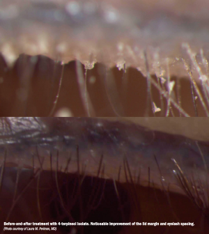 Treating Demodex blepharitis efficiently before surgery