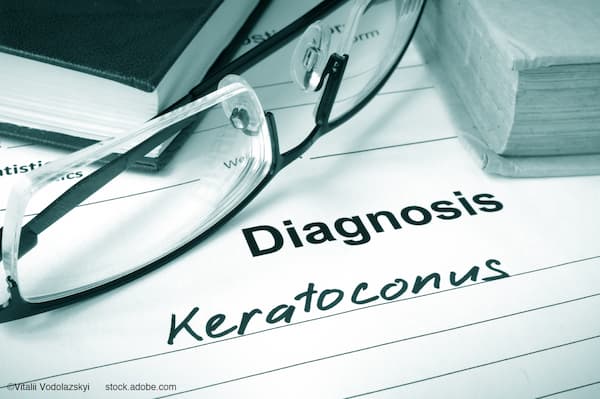 (Image credit: AdobeStock/Vitalii Vodolazskyi) Incision-free cross-linking marks a new era for keratoconus care