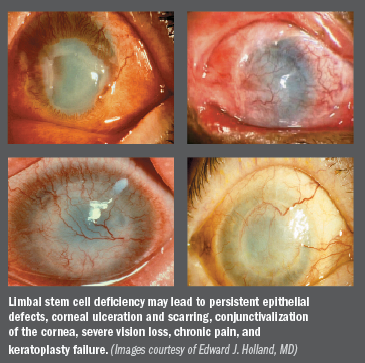 Dealing with limbal stem cell deficiency