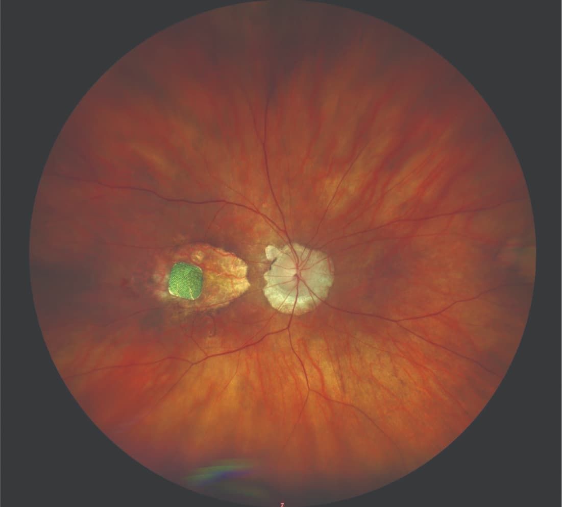 The implant is shown placed subretinally in an eye with geographic atrophy due to age-related macular degeneration. (Image courtesy of Frank G. Holz, MD, FEBO, FARVO) The implant is shown placed subretinally in an eye with geographic atrophy due to age-related macular degeneration. (Image courtesy of Frank G. Holz, MD, FEBO, FARVO)