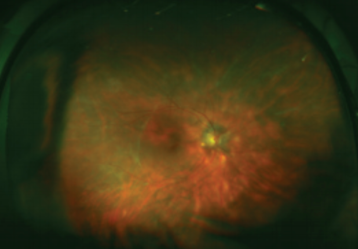 Tackling the challenge of noninfectious uveitis