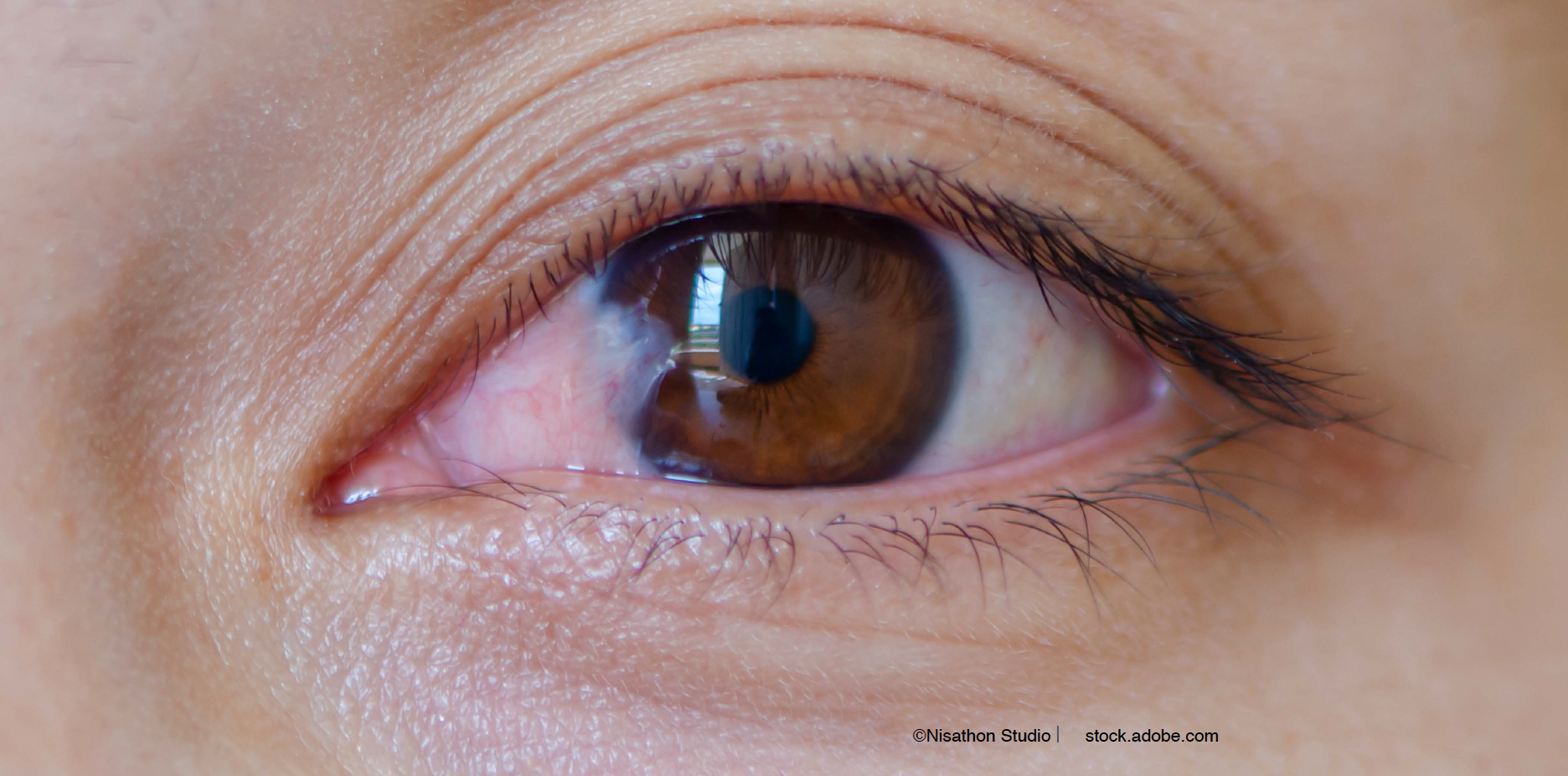 Novel amniotic membrane: A step ahead of other scaffolds for pterygia