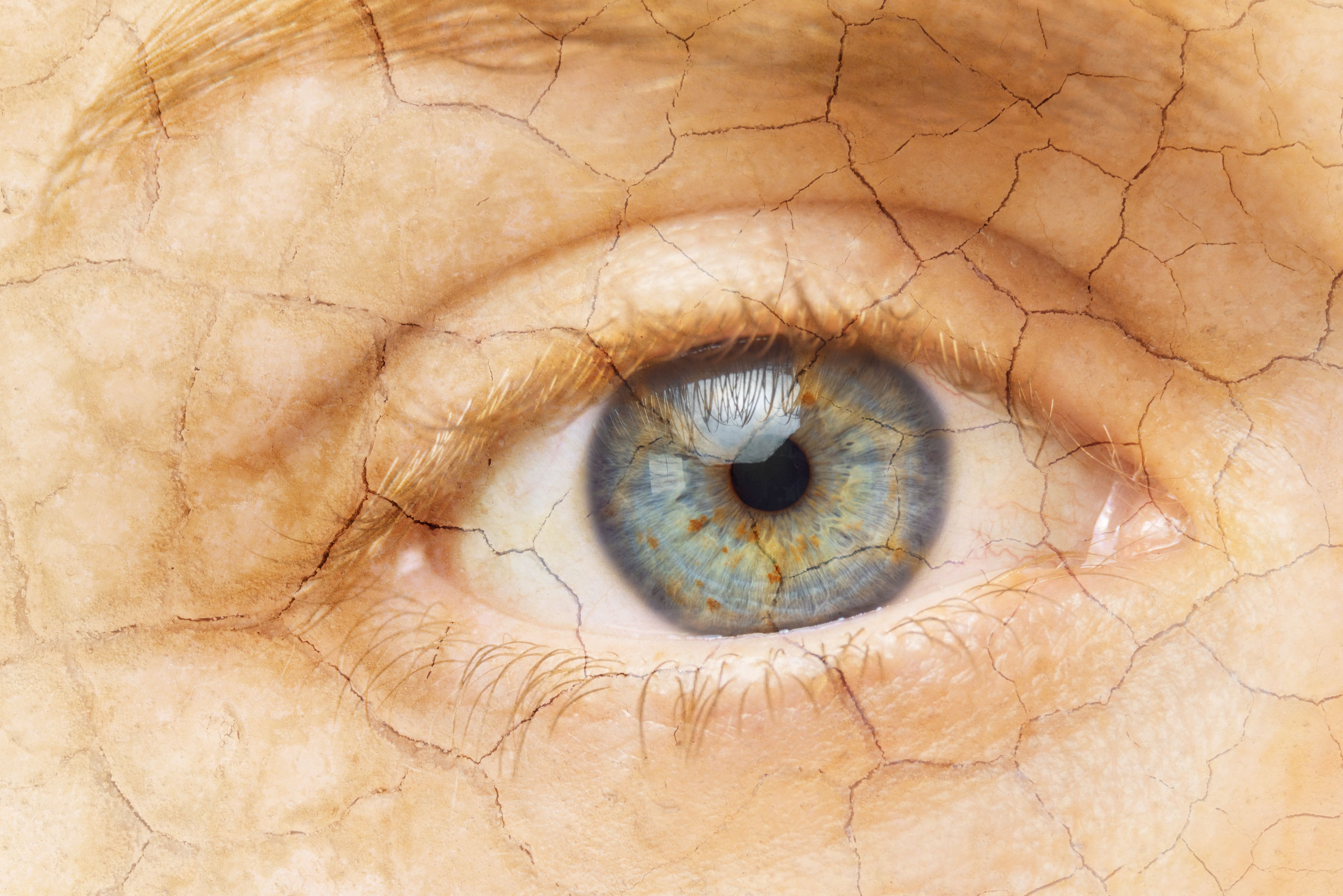Study: Dry eye disease alters how the eye’s cornea heals itself after injury