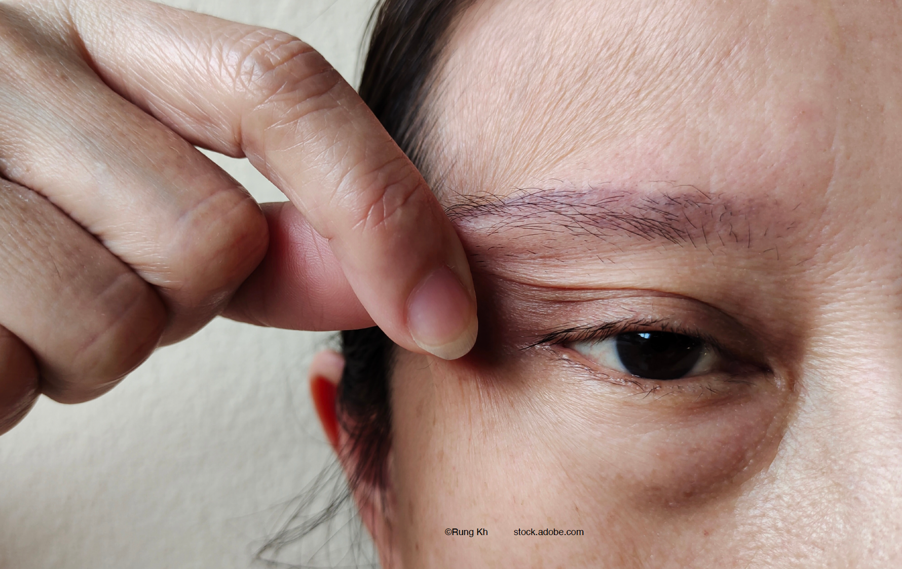 Shining the spotlight on psychogenic ptosis