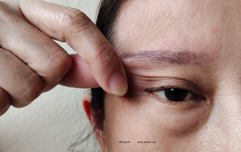 Shining the spotlight on psychogenic ptosis