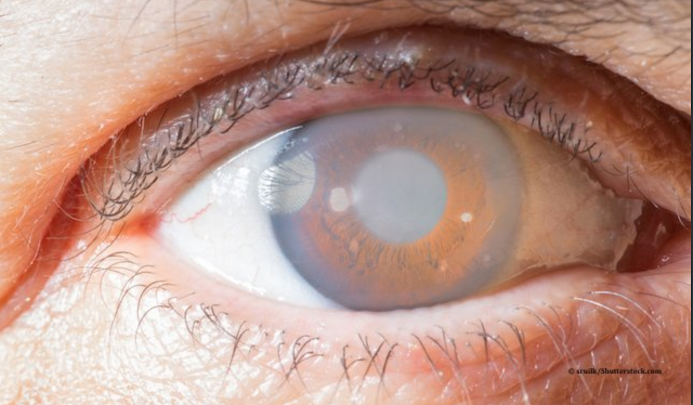 Surgery developed by ophthalmologist at Dean McGee Eye Institute proves its effectiveness Surgery developed by ophthalmologist at Dean McGee Eye Institute proves its effectiveness