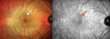 (FIGURE 1) A patient with acute macular neuroretinopathy in the right eye while taking fingolimod. There is subtle petaloid-shaped discoloration, superior to the fovea on multicolor image, and corresponding abnormal signal on near infrared image. (Photos courtesy of Bradley T. Smith, MD)
