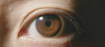 Challenges of treating peripheral hemorrhagic polypoidal choroidal vasculopathy