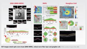 Keys to integrating, interpreting different types of OCT scans