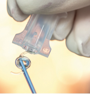 Haptic flanging reduces IOL dislocations after cataract surgery