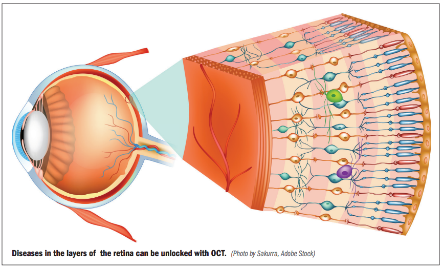 Diseases in the layers of the retina can be unlocked with OCT.