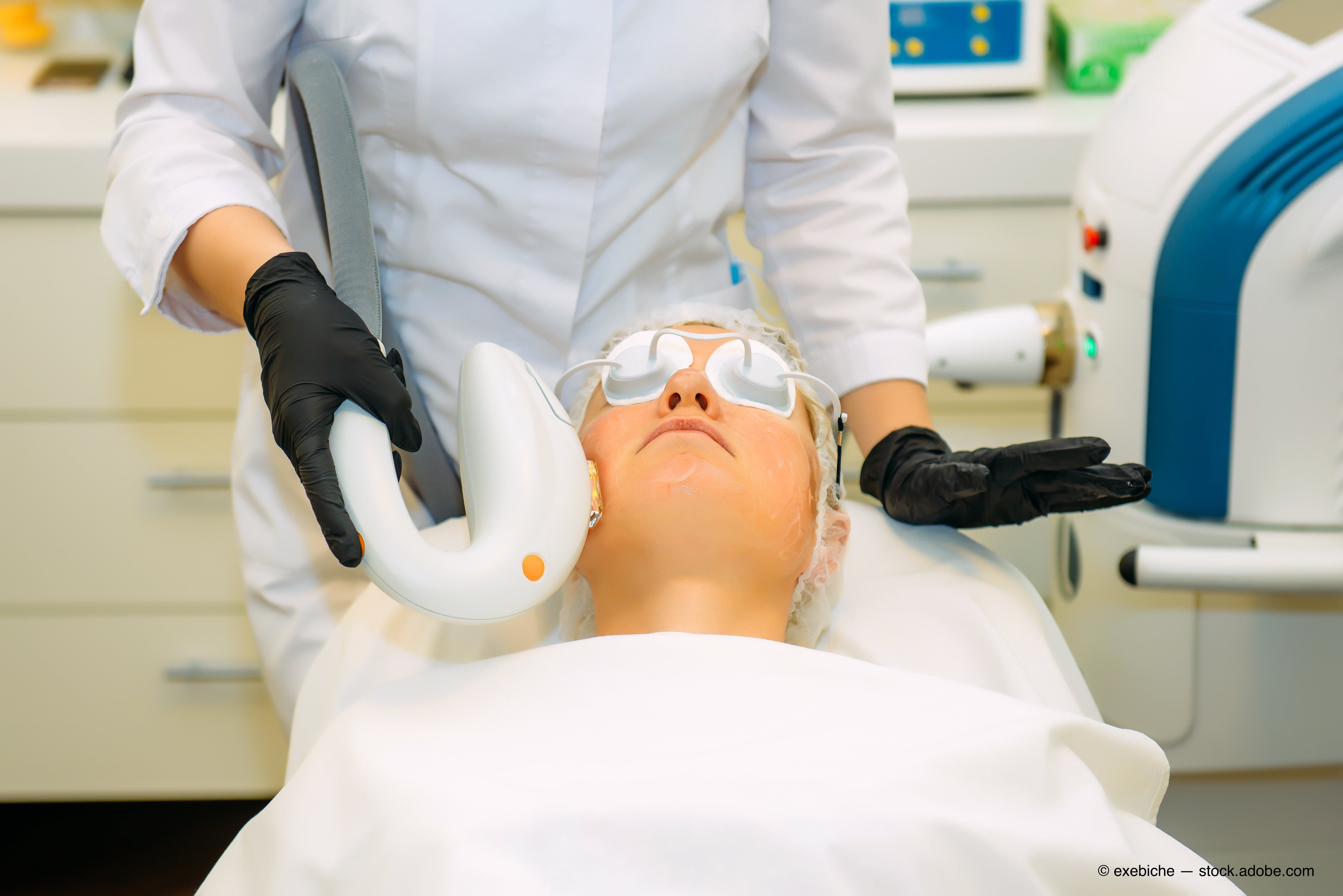 intense pulse light therapy 