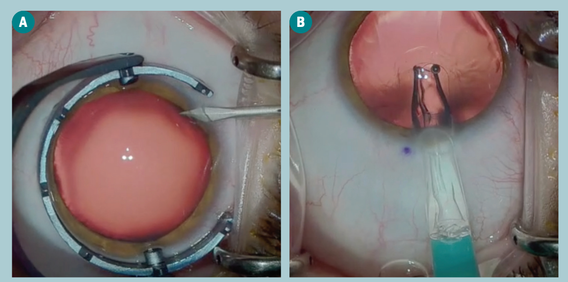 Images A, B, and C show the implantation of the ICL. (Images courtesy of Gregory D. Parkhurst, MD, FACS)