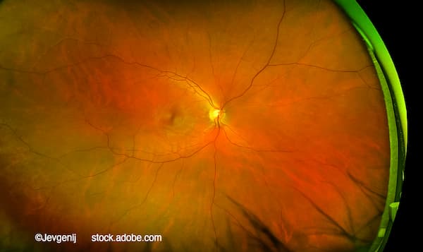 (Image credit: AdobeStock/Jevgenij) Q&A: Advancing a long-acting anti-VEGF candidate: What it means for retinal disease
