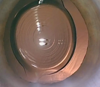 New presbyopia-correcting IOL provides spectacle independence