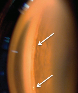 MIGS and cataract surgery option offers positive results