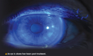Eye shown 4 hours post-treatment