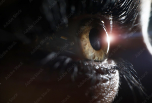 Surgeon offers pearls for the EVO Visian ICL