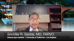 (Image credit: Ophthalmology Times) SriniVas Sadda, MD, on high-res OCT of atrophic and precursor lesions in AMD