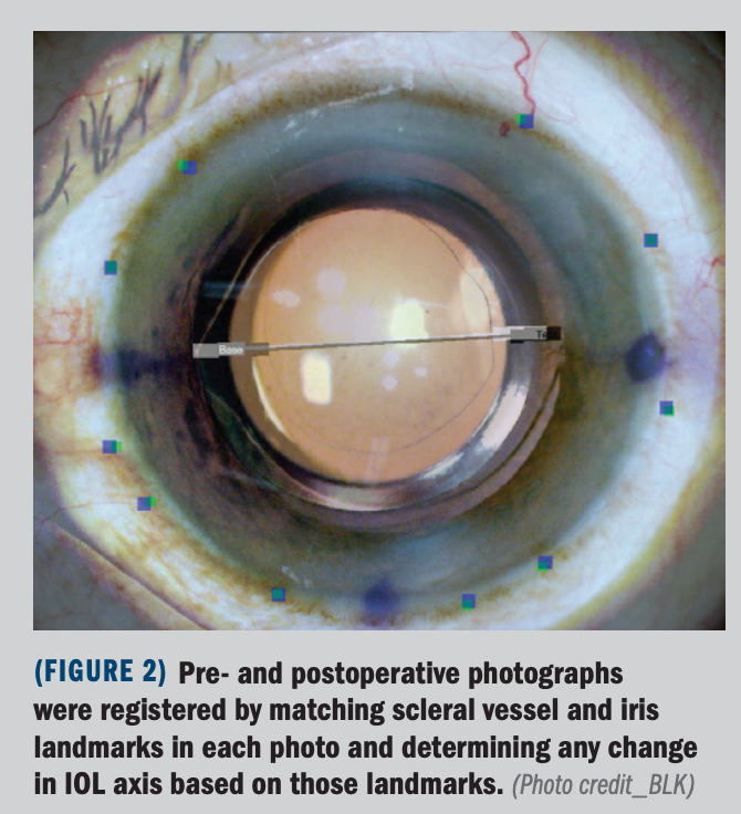 Figure 2: Pre- and postoperative photographs determined any change in IOL axis