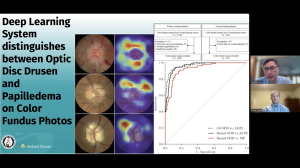NeuroOp Guru: Can AI distinguish between papilledema and optic disc drusen using color fundus photos?
