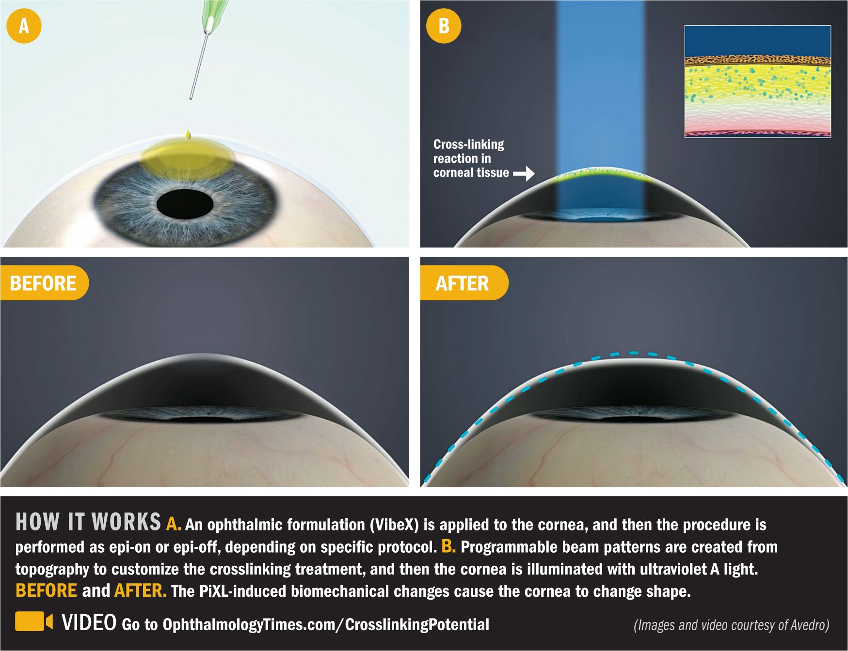 Crosslinking Showing Potential For Refractive Correction Ophthalmology Times