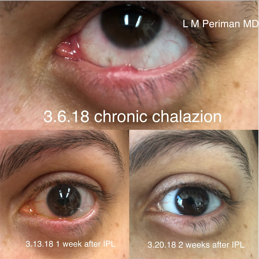 How Does A Chalazion Drain Naturally Best Drain Photos