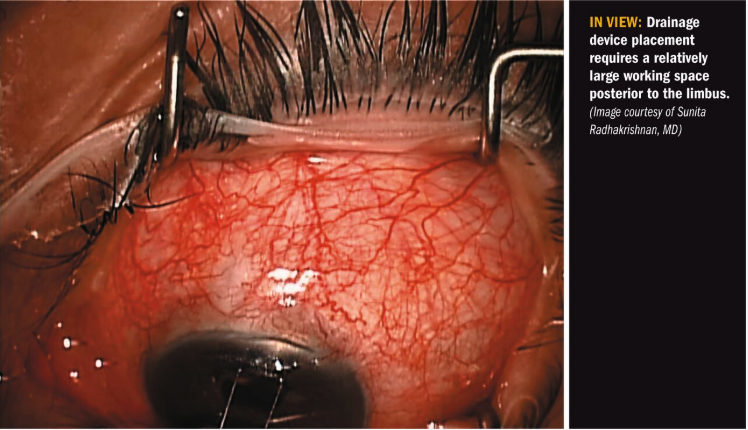 Drainage device placement 