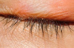 Targeted therapies improve care for Demodex blepharitis and OSD