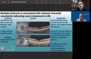 NeuroOp Guru: Multiple Sclerosis associated with reduced choroidal vascularity indicating uveal component to MS