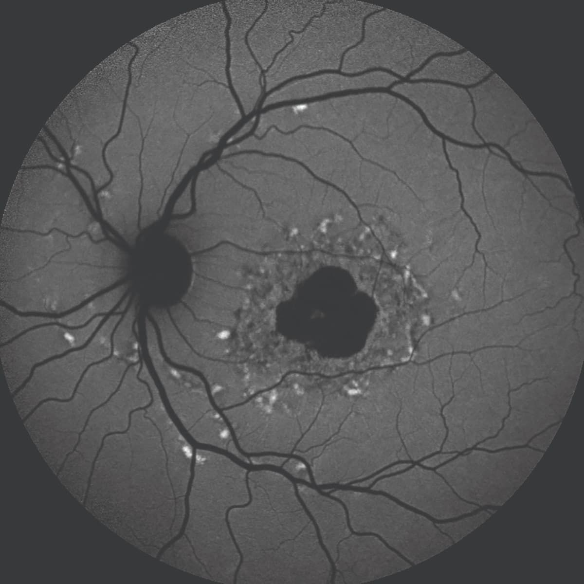 Figure 1 (top): A blue fundus autofluorescence image of the left eye of a woman aged 86 years with a multifocal pattern of geographic atrophy with perilesional hyperautofluorescence. Figure 2 (bottom): A blue fundus autofluorescence image of a patient with Stargardt disease. Note (1) the elongated pisciform deposits, which are hyperautofluorescent, and (2) the intensely deep hypoautofluorescence due to the accumulation of lipofuscin within the retinal pigment epithelium cells. Figure 1 (top): A blue fundus autofluorescence image of the left eye of a woman aged 86 years with a multifocal pattern of geographic atrophy with perilesional hyperautofluorescence. Figure 2 (bottom): A blue fundus autofluorescence image of a patient with Stargardt disease. Note (1) the elongated pisciform deposits, which are hyperautofluorescent, and (2) the intensely deep hypoautofluorescence due to the accumulation of lipofuscin within the retinal pigment epithelium cells.