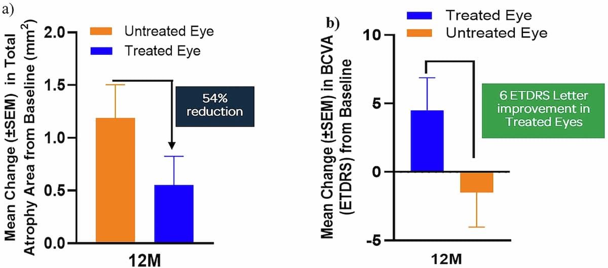 Treated eyes showed a decrease in atrophic lesion growth from baseline (a), and stabilisation/improvement in Visual Acuity (b).1 Treated eyes showed a decrease in atrophic lesion growth from baseline (a), and stabilisation/improvement in Visual Acuity (b).1