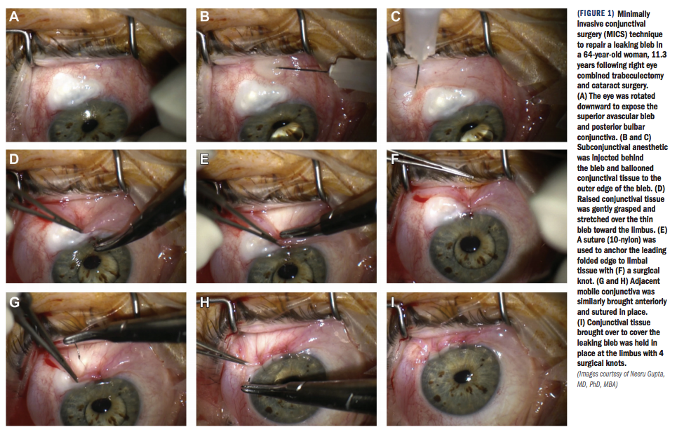 眼科手術のトラブルシューティング (新Eye Surgery Now No. 12) Bleb leaks treated with minimally invasive conjunctival