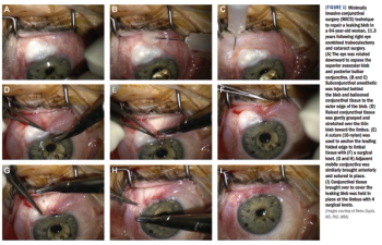 Minimally invasive conjunctival surgery (MICS)