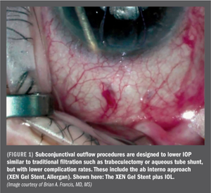 Which MIGS for which patient?