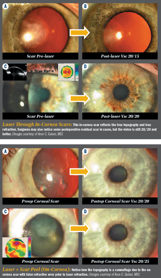 Decoding Corneal Scars Straight To 20 20