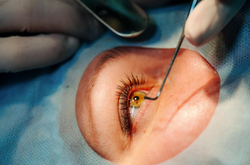Aetna drops policy requiring prior authorization for cataract surgery in 48 states 